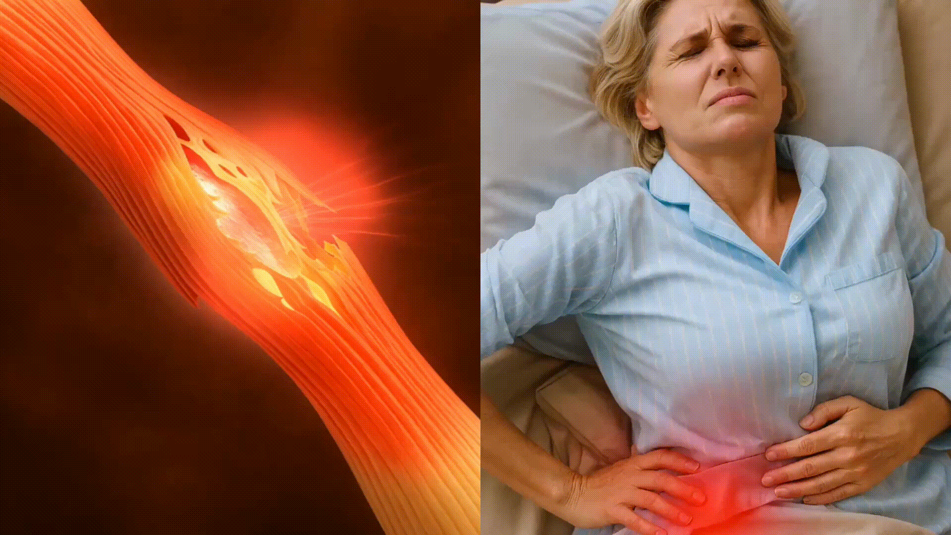 Tendinopathie fessière — HARMONIA™