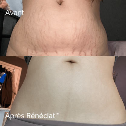 Rénéclat ™